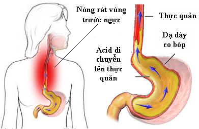 Trào ngược dạ dày thực quản là nguyên nhân gây khó chịu ở họng