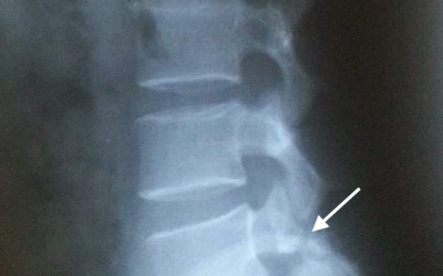 Khi một phần xương sống bị... thiếu hụt