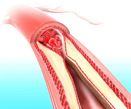 Tích tụ calci trong động mạch chỉ báo nguy cơ đau tim