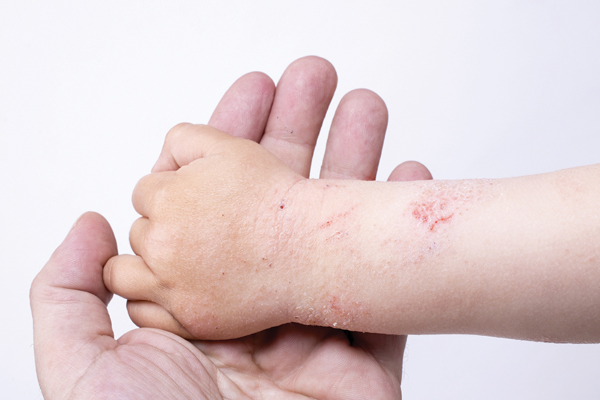 Viêm da cơ địa, bệnh mạn tính dễ tái phát