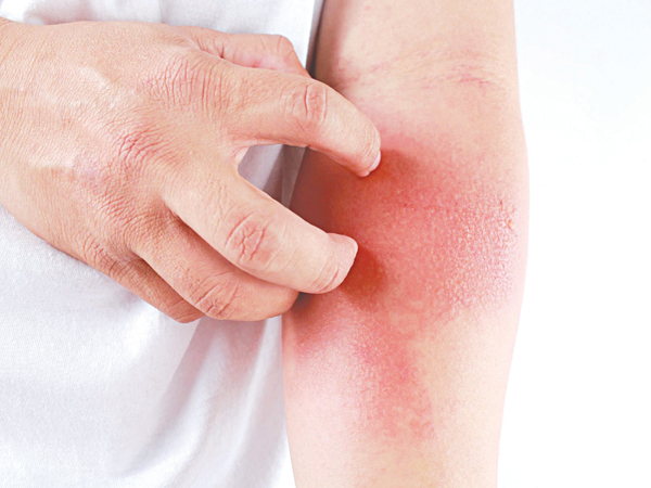 Viêm da cơ địa, bệnh mạn tính dễ tái phát