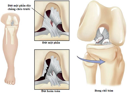 Nhận biết mất vững khớp gối do tổn thương dây chằng chéo trước