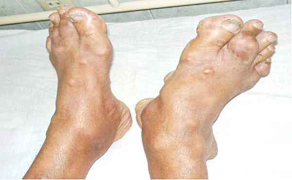 Bệnh gout ở người trẻ - chớ xem thường!
