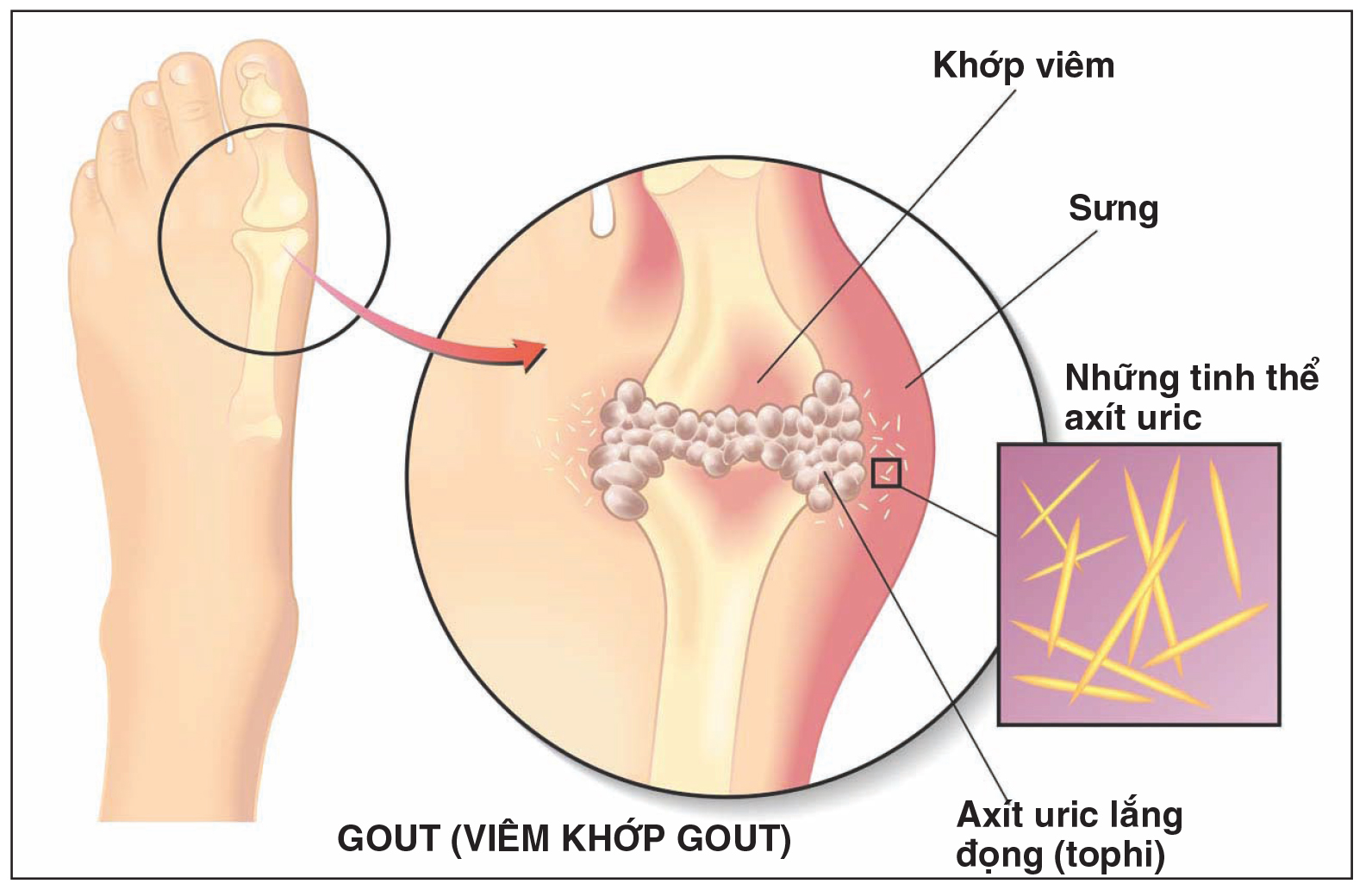 Bệnh gout ở người trẻ - chớ xem thường!