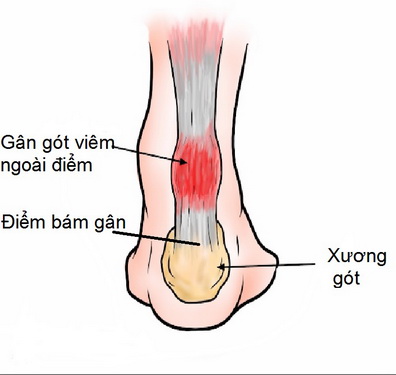 Gân gót bị viêm ngoài điểm.