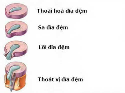 Hình ảnh thoát vị đĩa đệm.