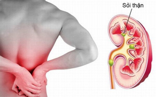 Hình ảnh mô tả sỏi thận và vị trí đau khi bị sỏi thận.