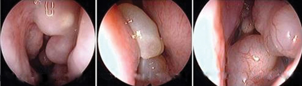 Điều cần biết về polyp mũi