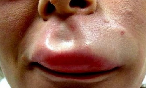 Sưng môi do côn trùng cắn, đốt.