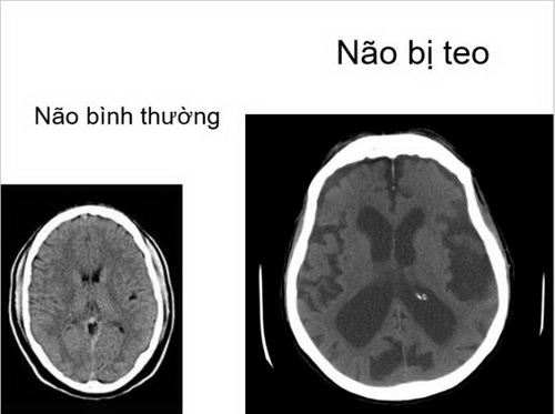 Tổn thương não ở người nghiện rượu.
