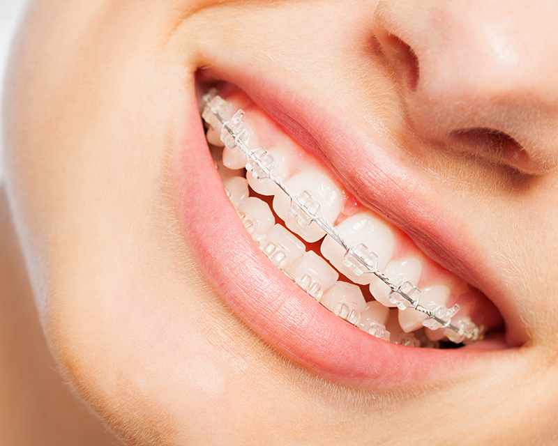 What to Know Before Getting Clear Ceramic Braces | Carmel IN
