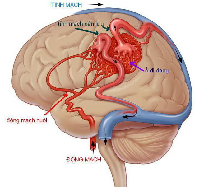 Dị dạng mạch máu là bệnh bẩm sinh