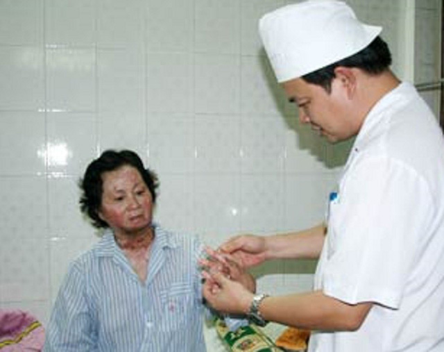 Bác sĩ khám chữa cho một bệnh nhân bỏng. Ảnh: TL