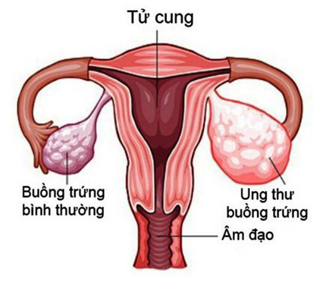 Nhiều trẻ chưa 15 tuổi đã mắc ung thư buồng trứng, đừng chủ quan khi thấy dấu hiệu này - Ảnh 1.