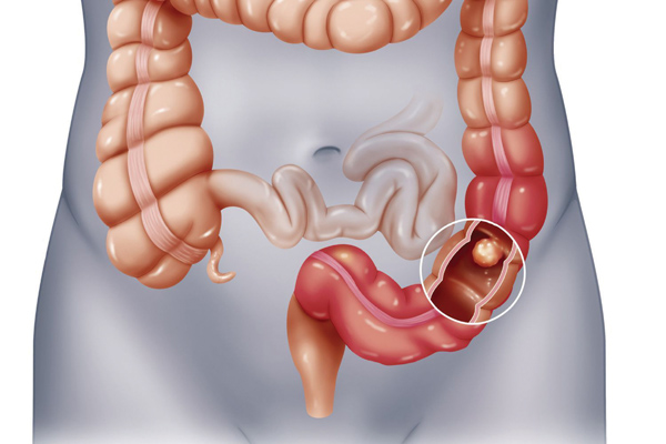 Tiêu chảy phân mỡ và nguy cơ với sức khỏe