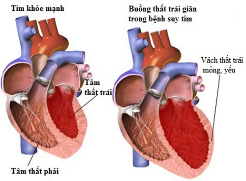Suy thất trái là biến chứng quan trọng của nhồi máu cơ tim.