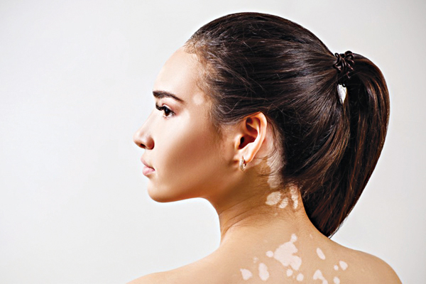 Điều trị bạch biến