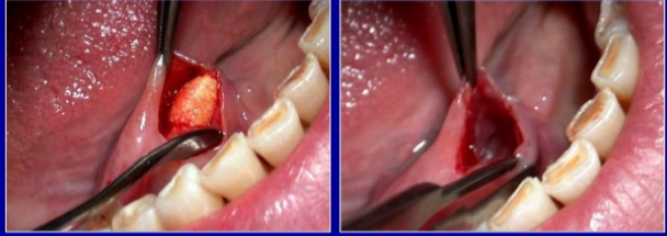 Vôi hóa tuyến nước bọt