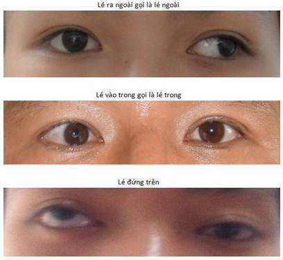 Lác mắt ở trẻ em ngày càng tăng.