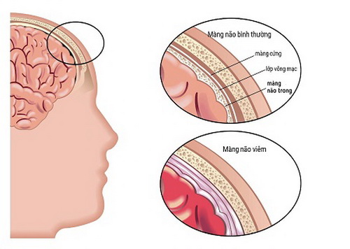 Viêm màng não do virut gây nhiều biến chứng nguy hiểm cho trẻ.