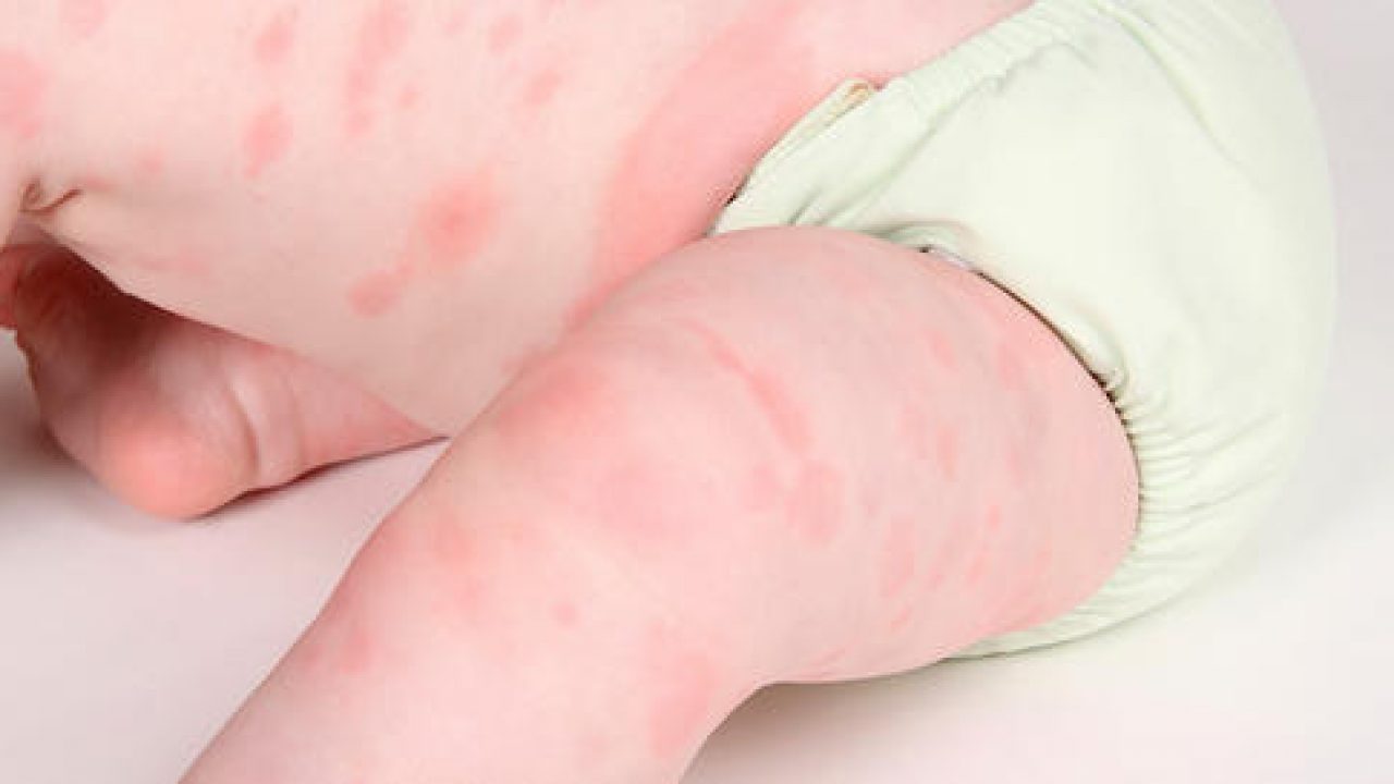 Dấu hiệu và cách chữa trị viêm da dị ứng