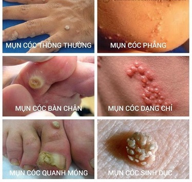 Mụn cóc thường gặp phát triển trên da do virut HPV.
