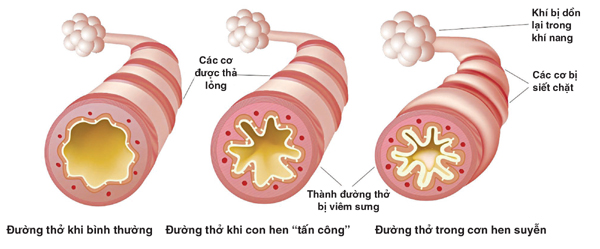 Biến chứng của bệnh hen phế quản