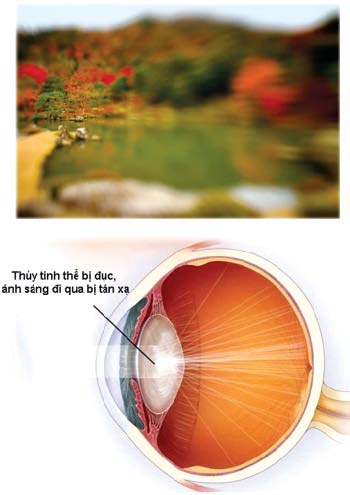 đục thủy tinh thể trẻ hóa
