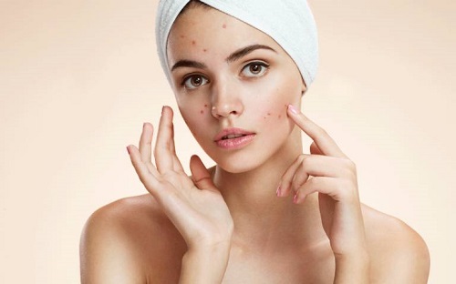 cách trị mụn tại nhà