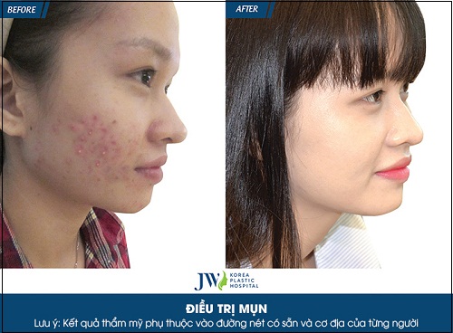 trước và sau khi điều trị mụn tại bệnh viện thẩm mỹ hàn quốc jw