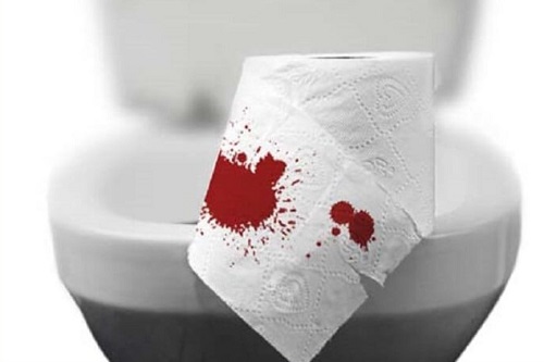 Top nguyên nhân gây bệnh trĩ ngoại và cách khắc phục