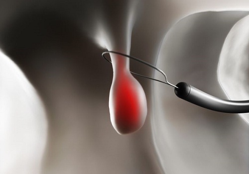 Polyp hậu môn là gì? Một vài lưu ý khi sau khi phẫu thuật/cắt polyp hậu môn - Phòng Khám Đa Khoa An Giang
