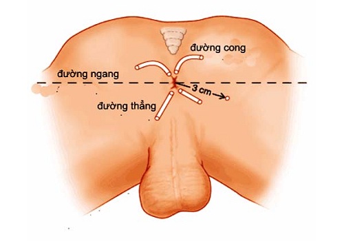 Những biến chứng sau mổ rò hậu môn mà bạn nên biết