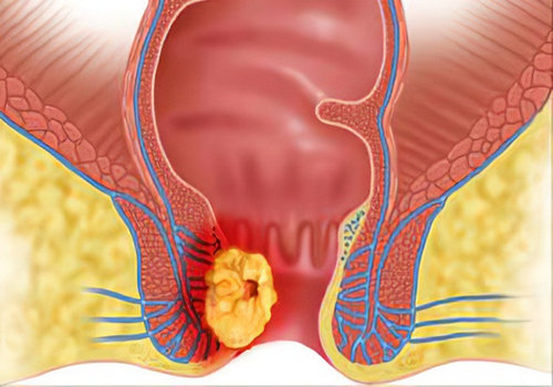 Rò hậu môn: nguyên nhân, dấu hiệu và cách chữa trị