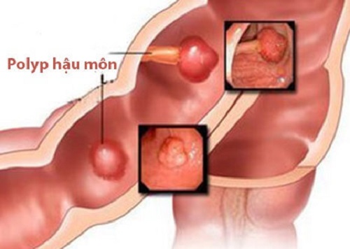 Polyp hậu môn: nguyên nhân, dấu hiệu, hình ảnh và cách chữa trị - Phòng Khám Đa Khoa An Giang