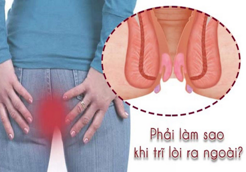 Lòi dom có nguy hiểm không? Phương pháp điều trị