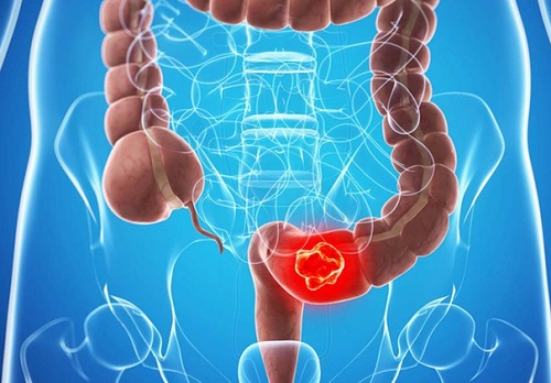 Lòi con trê là dấu hiệu của bệnh gì? Cách chữa trị hiệu quả