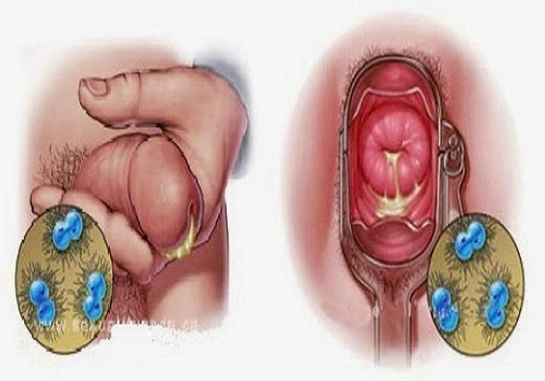 Triệu chứng bệnh lậu giai đoạn đầu nhiều người chưa biết