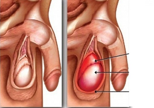 Thỉnh thoảng đau nhói ở tinh hoàn là dấu hiệu gì?