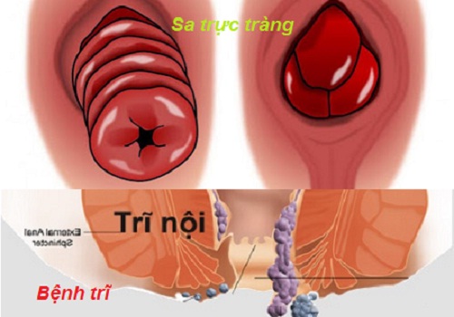 Tác hại của táo bón lâu ngày - ai cũng phải biết