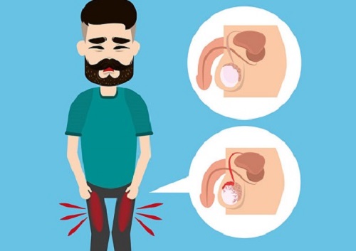 Thuốc điều trị tiền liệt tuyến phì đại và một số lưu ý