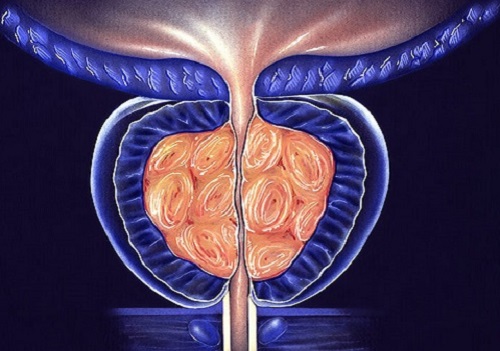 Các nguyên nhân của bệnh phì đại tuyến tiền liệt ở nam giới