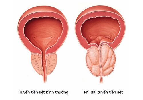 Cách chữa/điều trị bệnh phì đại tiền liệt tuyến ở nam giới
