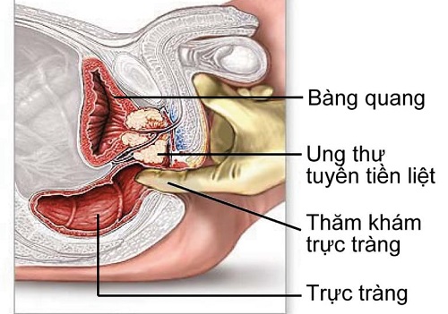 Cách chữa/ điều trị ung thư tiền liệt tuyến an toàn