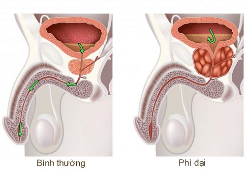 Tuyến tiền liệt của nam giới nằm ở đâu?