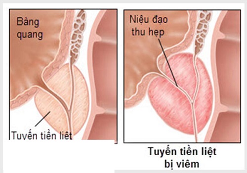Bệnh viêm tuyến tiền liệt ở nam giới: Nguyên nhân, dấu hiệu và cách chữa trị