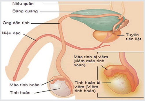 Các biểu hiện của bệnh viêm tinh hoàn ở nam giới