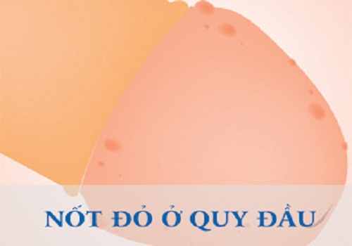Các dấu hiệu triệu chứng viêm bao quy đầu ở nam giới