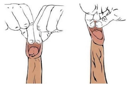 Có nên kéo bao quy đầu xuống không? Chuyên gia chia sẻ