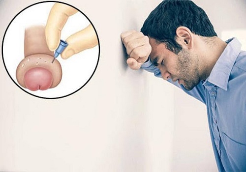 Sưng bao quy đầu ở nam giới là bệnh gì? Cách chữa trị nhanh